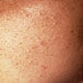 Skin1