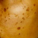 HYPER PIGMENTATIONSkin1