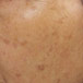 HYPER PIGMENTATION Skin2