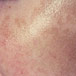 HYPER PIGMENTATION Skin3