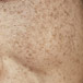 HYPER PIGMENTATION Skin4